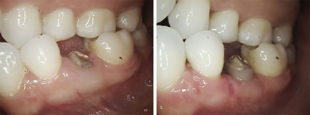 Crown Lengthening #1 in Lakewood, NJ