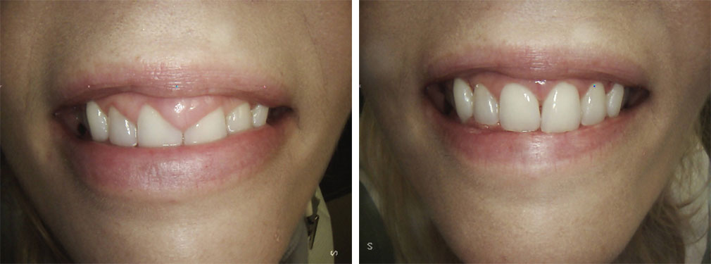 Aesthetic Gingival Re-contouring #1 in Lakewood, NJ