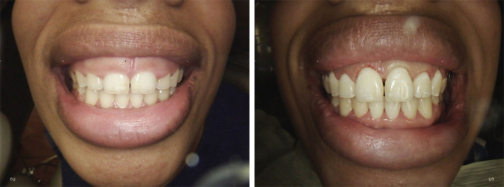 Aesthetic Gingival Re-contouring #2 in Lakewood, NJ