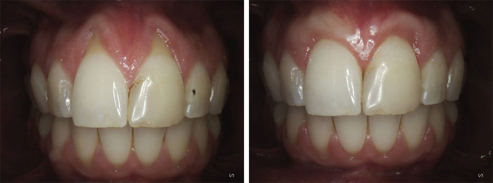 Gum/Soft Tissue Grafting #1 in Lakewood, NJ