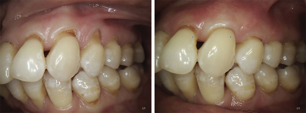 Gum/Soft Tissue Grafting #2 in Lakewood, NJ