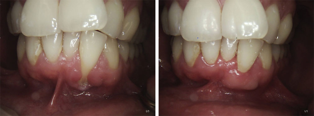 Gum/Soft Tissue Grafting #3 in Lakewood, NJ